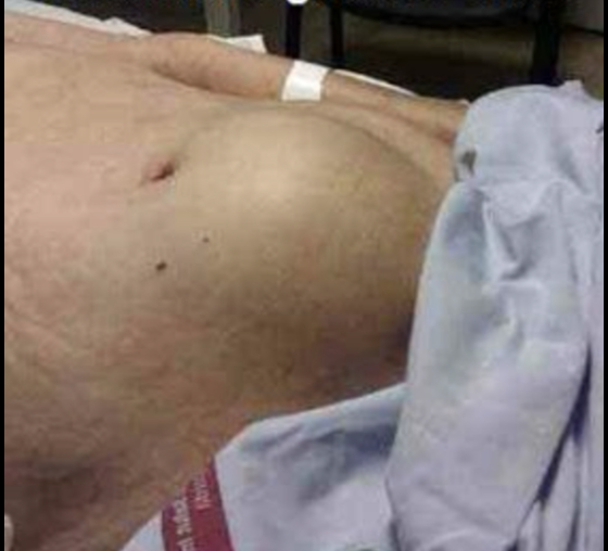 Paciente en un servicio de urgencias tras la instalación de una sonda vesical por retención urinaria