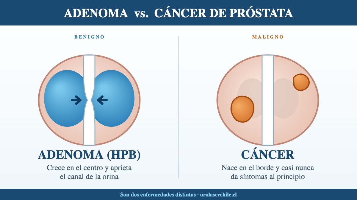 Comparación ilustrada: el adenoma crece en el centro de la próstata y estrecha el canal urinario; el cáncer nace en la zona periférica