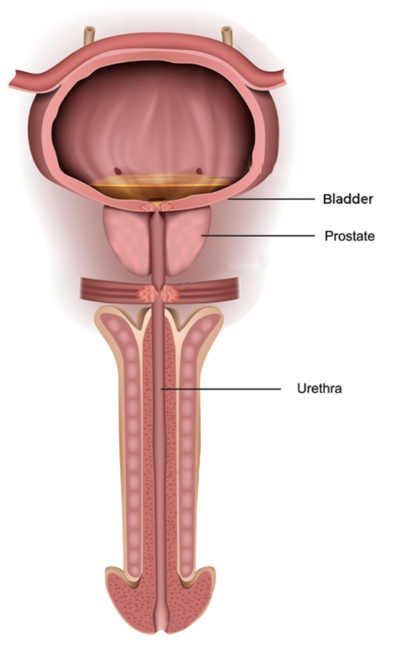 Anatomía de la próstata: vejiga, próstata y uretra, con el adenoma comprimiendo el canal urinario