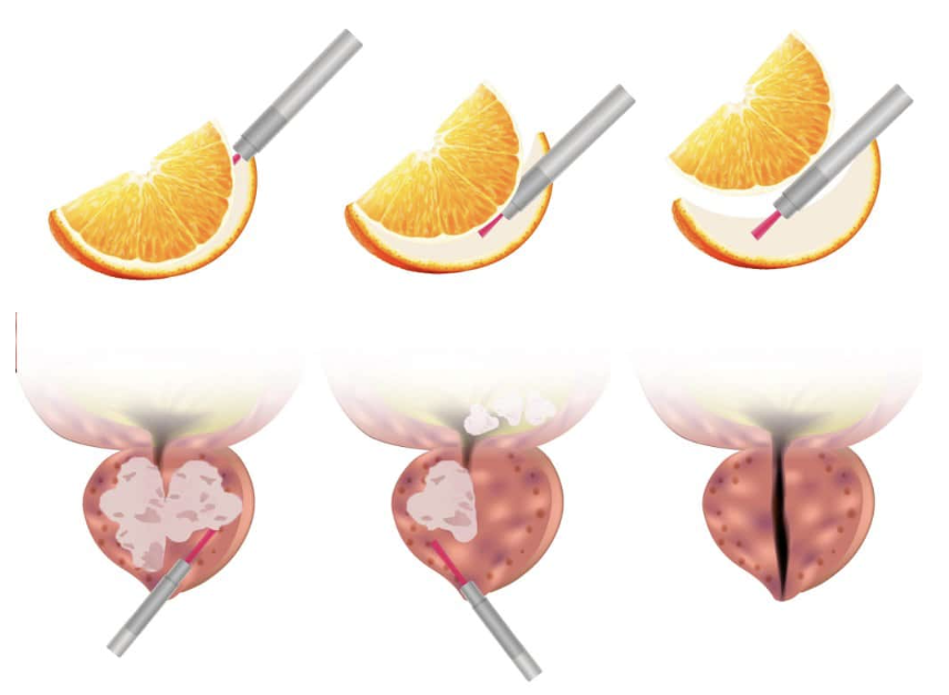 Secuencia del HoLEP: el láser de holmio separa el adenoma de la cápsula prostática, igual que se separa el gajo de naranja de su cáscara
