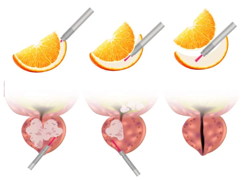 Secuencia del HoLEP: el láser de holmio separa el adenoma de la cápsula prostática, igual que se separa el gajo de naranja de su cáscara