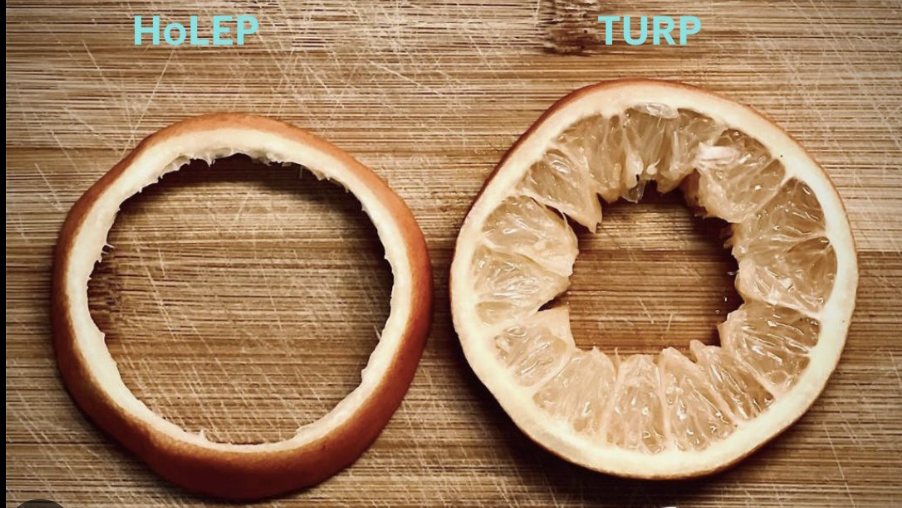 Comparación entre HoLEP y RTU con naranjas: a la izquierda solo queda la cáscara, como la cápsula prostática tras el HoLEP; a la derecha queda pulpa, como el tejido residual de la RTU