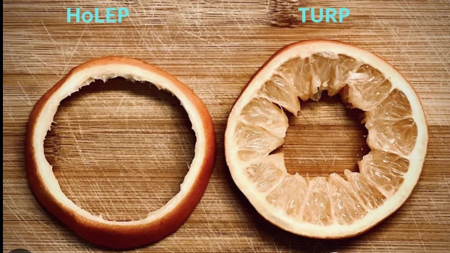 Comparación entre HoLEP y RTU con naranjas: a la izquierda solo queda la cáscara, como la cápsula prostática tras el HoLEP; a la derecha queda pulpa, como el tejido residual de la RTU