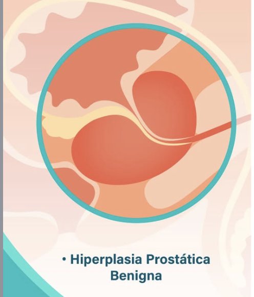 Ilustración de la hiperplasia prostática benigna (adenoma de próstata)