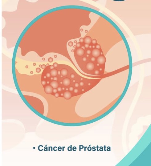 Ilustración del cáncer de próstata